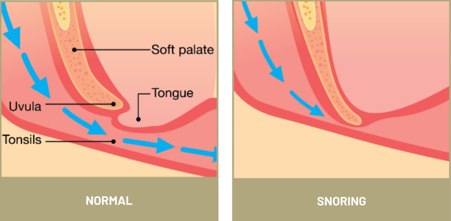 Snoring infographic